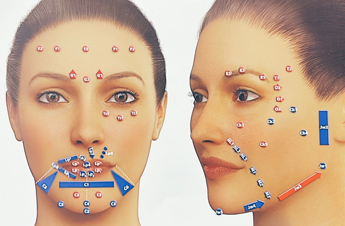 MD-Codes™ Gesichtsareale – schematische Darstellung der Injektionspunkte für Fillerbehandlungen im Mittel- und Untergesicht.